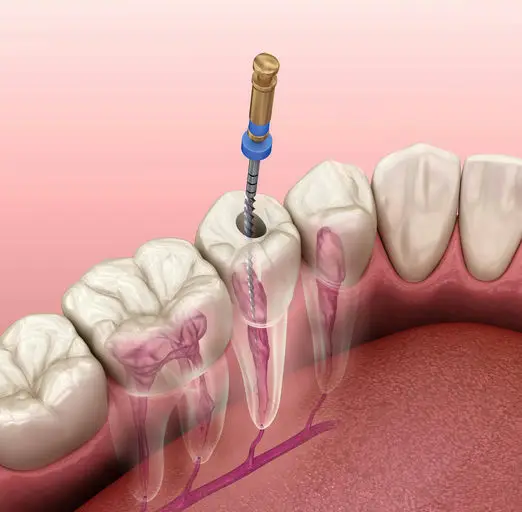 Root canal treatment shown on a tooth model