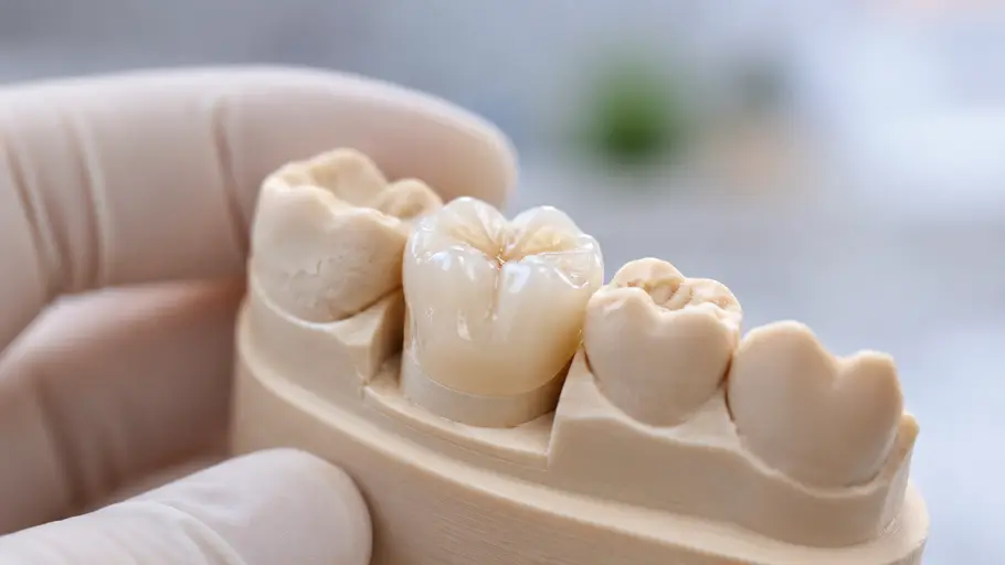 Dental crown on a tooth model