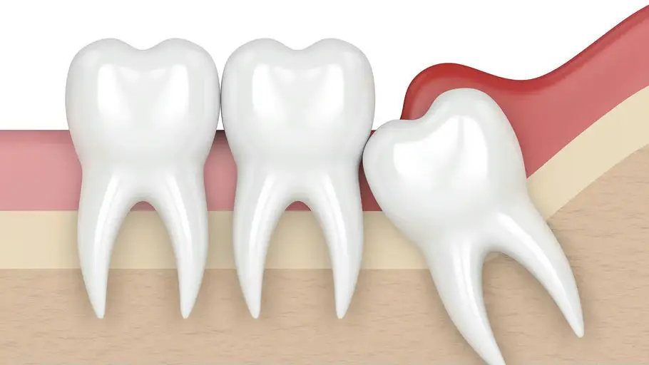 Model showing the position of a wisdom tooth