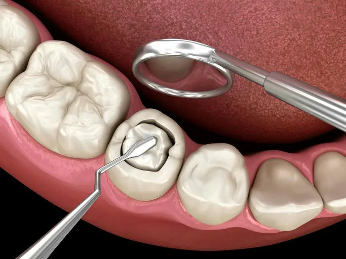 Tooth model showing a filling